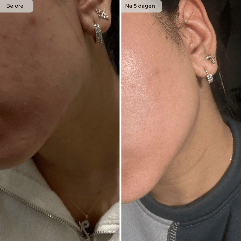 Voor en na resultaat NAWSER Hendia Face Oil