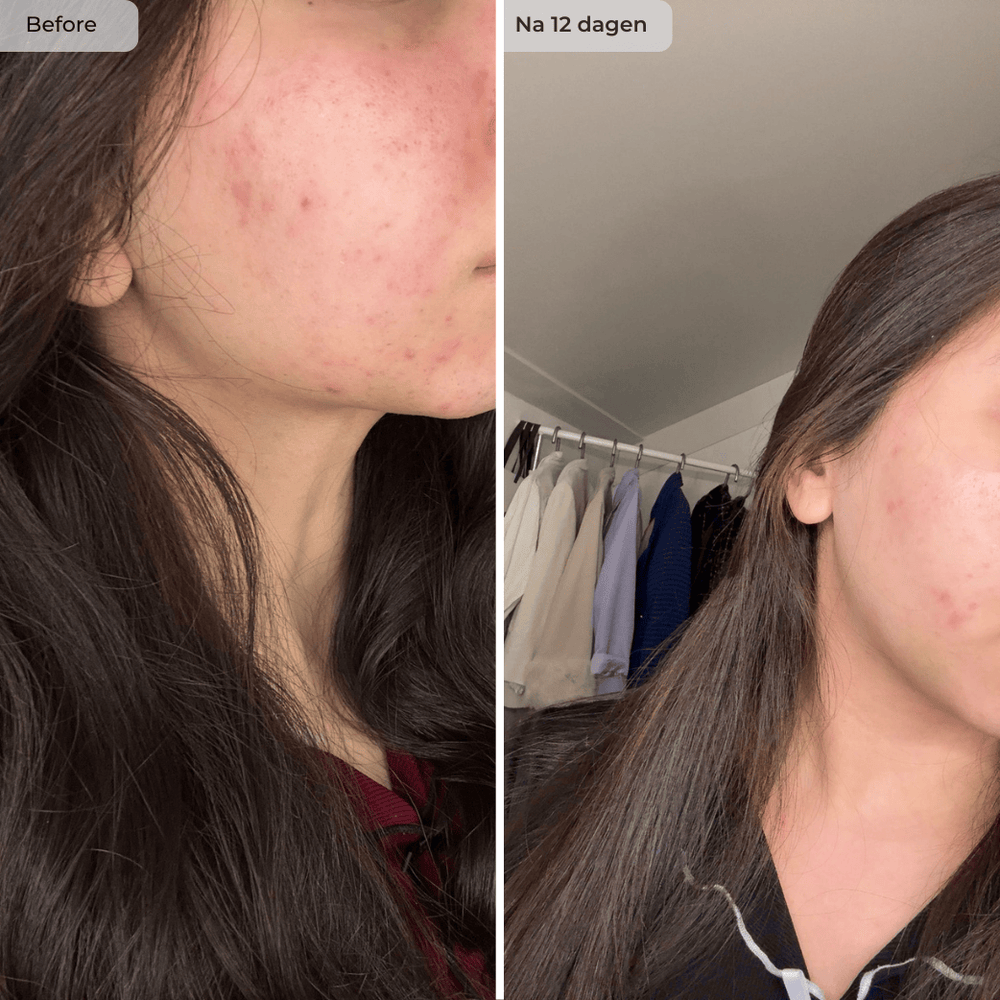 Voor en na resultaat NAWSER Hendia Face Oil