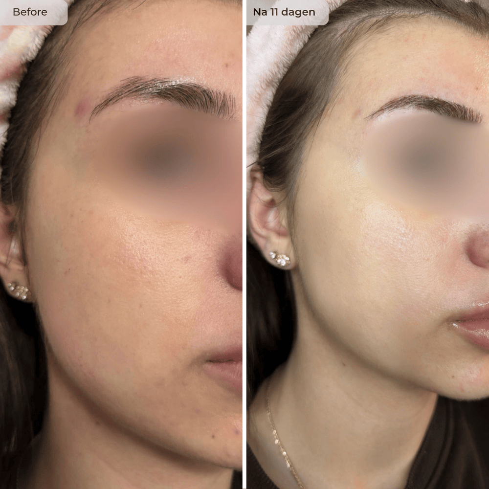 Voor en na resultaat NAWSER Hendia Face Oil